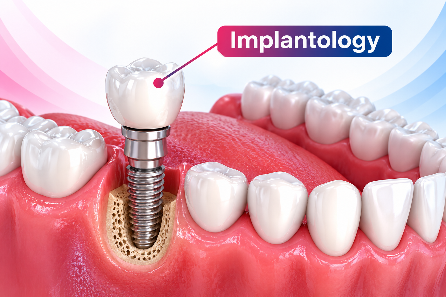Dental Implantology